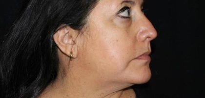Skin Tightening Before & After Patient #16896