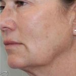 Skin Tightening Before & After Patient #16947