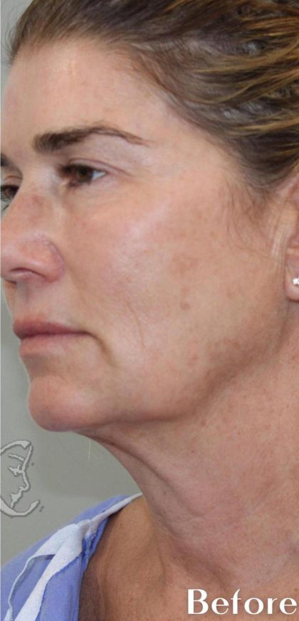 Skin Tightening Before & After Patient #16947