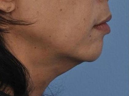 Skin Tightening Before & After Patient #16898