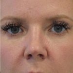 Skin Tightening Before & After Patient #16901