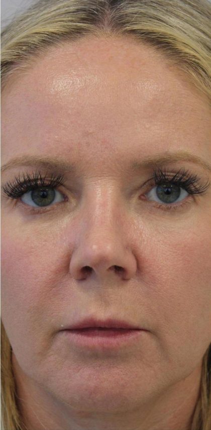 Skin Tightening Before & After Patient #16901