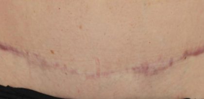 Scars & Keloids Before & After Patient #16698