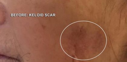 Scars & Keloids Before & After Patient #16699