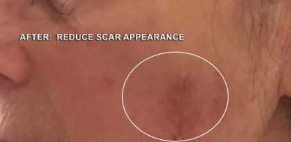 Scars & Keloids Before & After Patient #16699