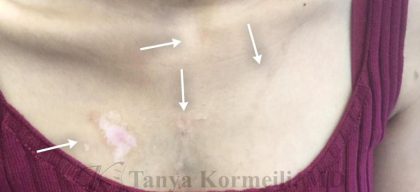 Scars & Keloids Before & After Patient #16702