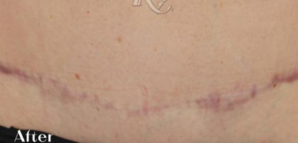 Scars & Keloids Before & After Patient #16704