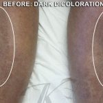 Skin Tone & Texture Before & After Patient #17820