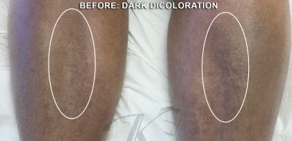 Skin Tone & Texture Before & After Patient #17820