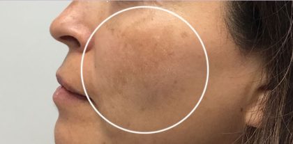 Skin Tone & Texture Before & After Patient #17835