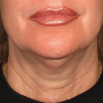 Necks & Jawline Before & After Patient #17225