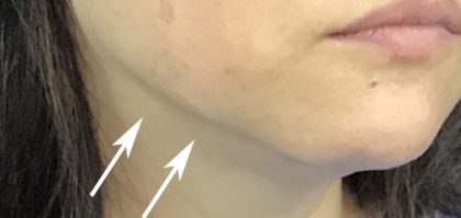 Necks & Jawline Before & After Patient #17237