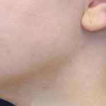 Necks & Jawline Before & After Patient #17240