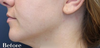 Necks & Jawline Before & After Patient #17240