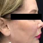 Necks & Jawline Before & After Patient #17250