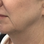 Necks & Jawline Before & After Patient #17266