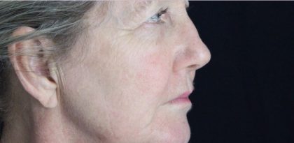 Skin Tone & Texture Before & After Patient #17841