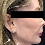 Necks & Jawline Before & After Patient #17250