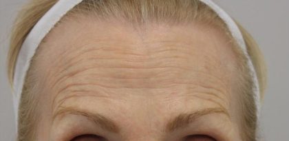 Lines & Wrinkles Before & After Patient #17534