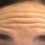 Lines & Wrinkles Before & After Patient #17552