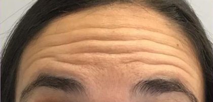 Lines & Wrinkles Before & After Patient #17552