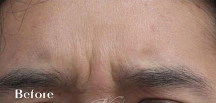 Lines & Wrinkles Before & After Patient #17537