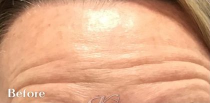 Lines & Wrinkles Before & After Patient #17539