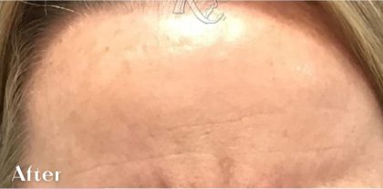 Lines & Wrinkles Before & After Patient #17539