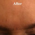 Lines & Wrinkles Before & After Patient #17542