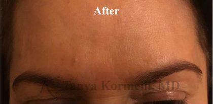 Lines & Wrinkles Before & After Patient #17542