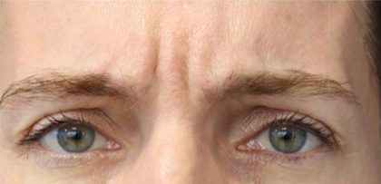 Lines & Wrinkles Before & After Patient #17518