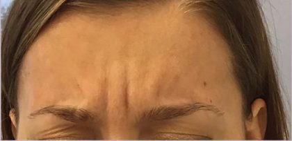 Lines & Wrinkles Before & After Patient #17544