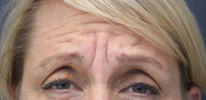 Lines & Wrinkles Before & After Patient #17546