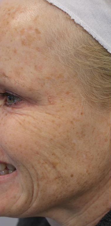 Lines & Wrinkles Before & After Patient #17354