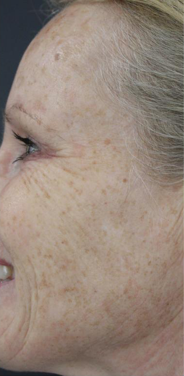 Lines & Wrinkles Before & After Patient #17548