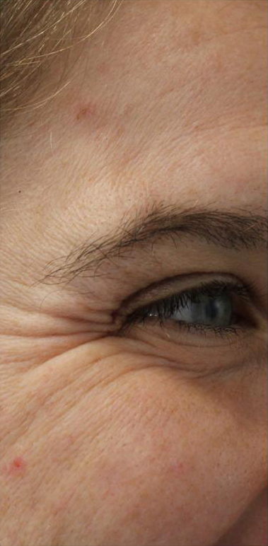 Lines & Wrinkles Before & After Patient #17355