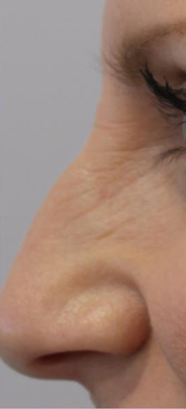 Lines & Wrinkles Before & After Patient #17356
