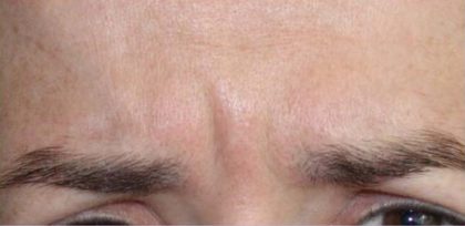 Lines & Wrinkles Before & After Patient #17727