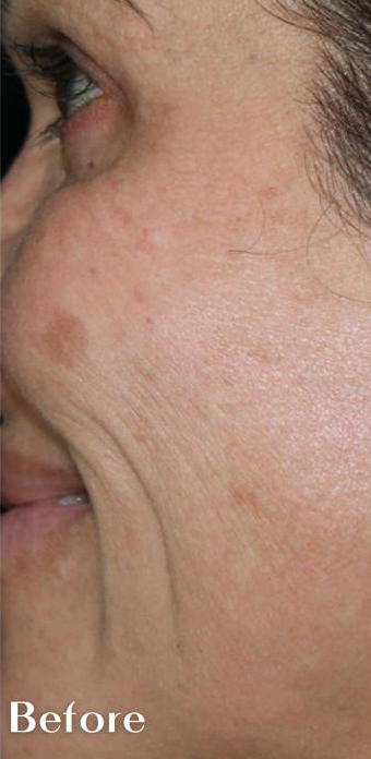 Lines & Wrinkles Before & After Patient #17357