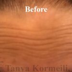 Lines & Wrinkles Before & After Patient #17732