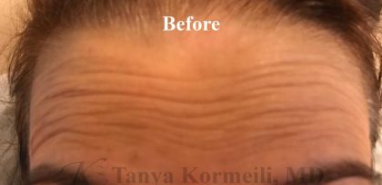Lines & Wrinkles Before & After Patient #17732