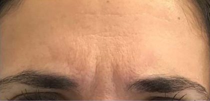 Lines & Wrinkles Before & After Patient #17733