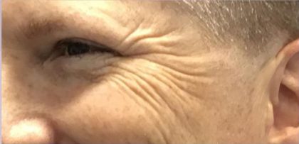 Lines & Wrinkles Before & After Patient #17735