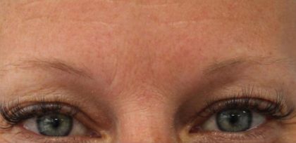 Lines & Wrinkles Before & After Patient #17741