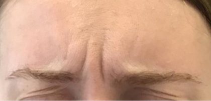 Lines & Wrinkles Before & After Patient #17743