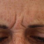 Lines & Wrinkles Before & After Patient #17522