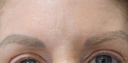 Lines & Wrinkles Before & After Patient #17751