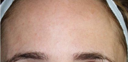 Lines & Wrinkles Before & After Patient #17755