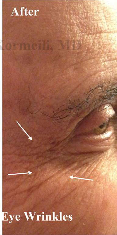 Lines & Wrinkles Before & After Patient #17358