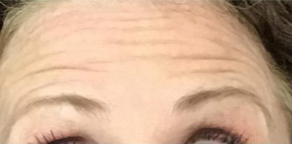 Lines & Wrinkles Before & After Patient #17525